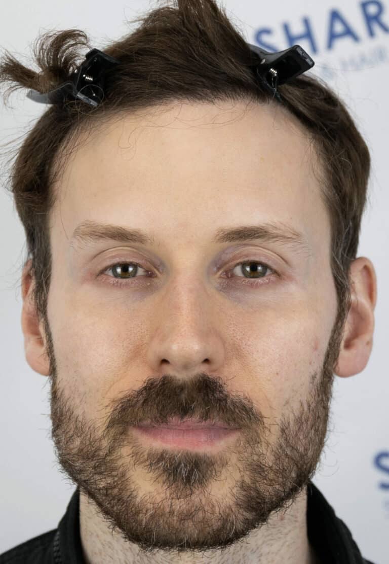 William-After-36yo-2500-grafts-hairline-mid-scalp-Front