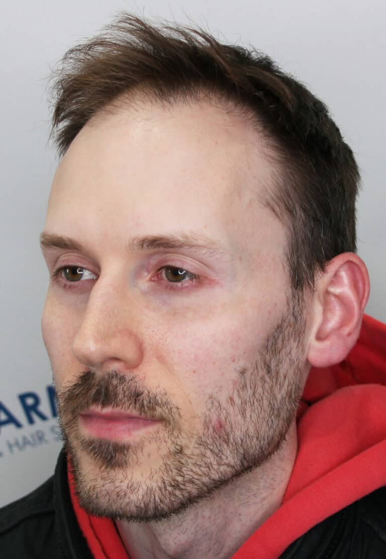 William-Before-36yo-2500-grafts-hairline-mid-scalp-45Left