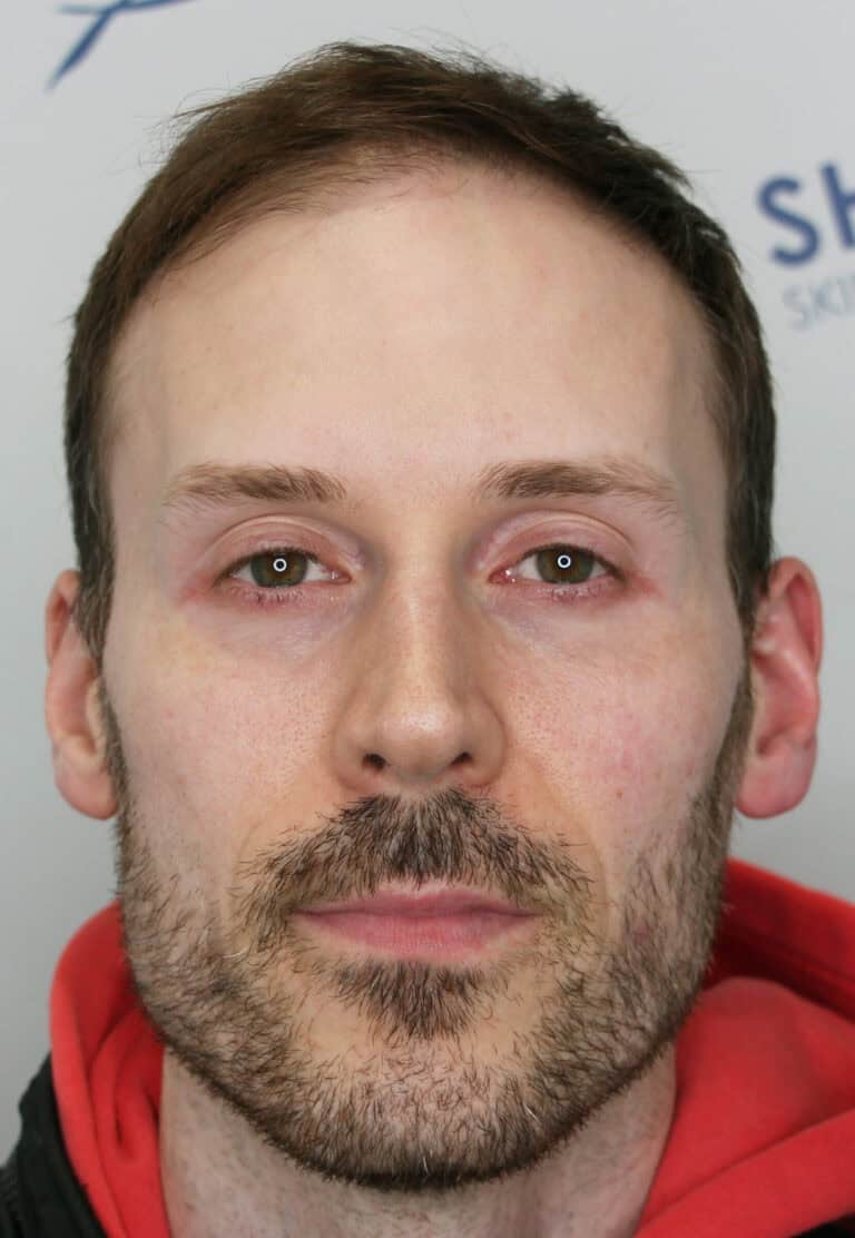 William-Before-36yo-2500-grafts-hairline-mid-scalp-Front