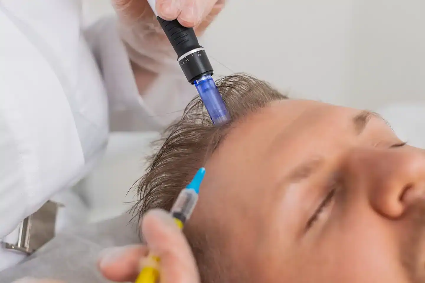 image-service-microneedling