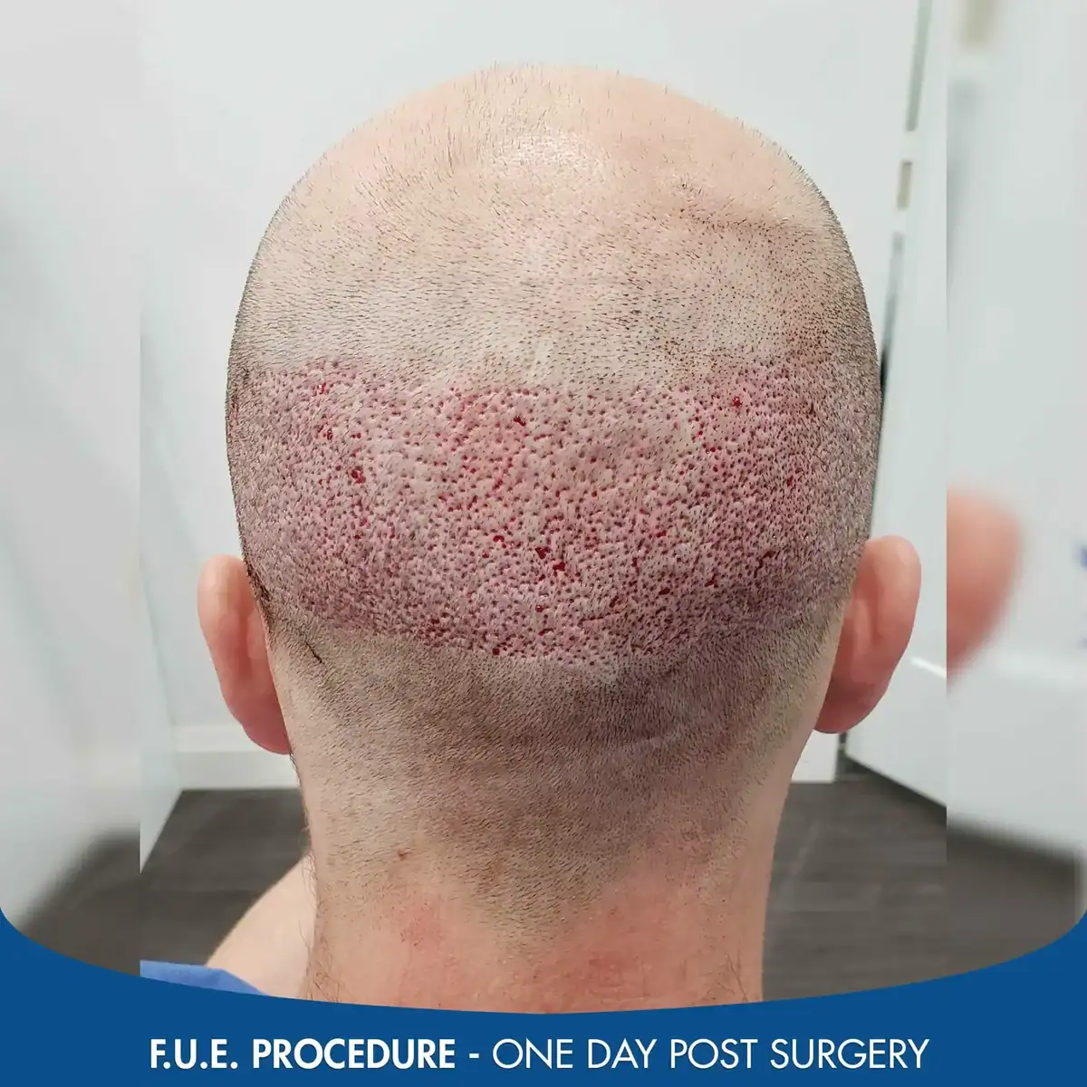 FUE-scar-one-day-post-procedure-1