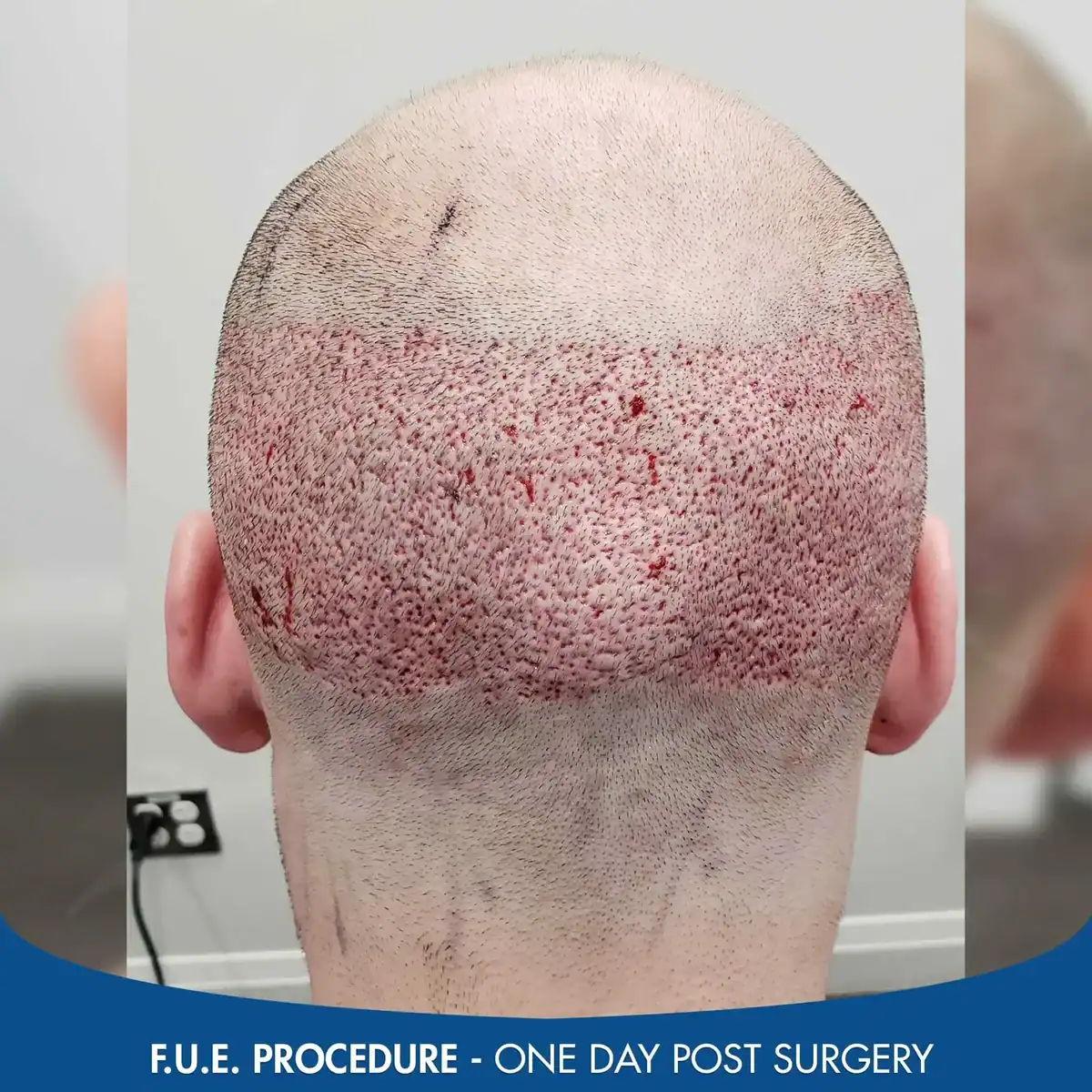 FUE-scar-one-day-post-procedure-2