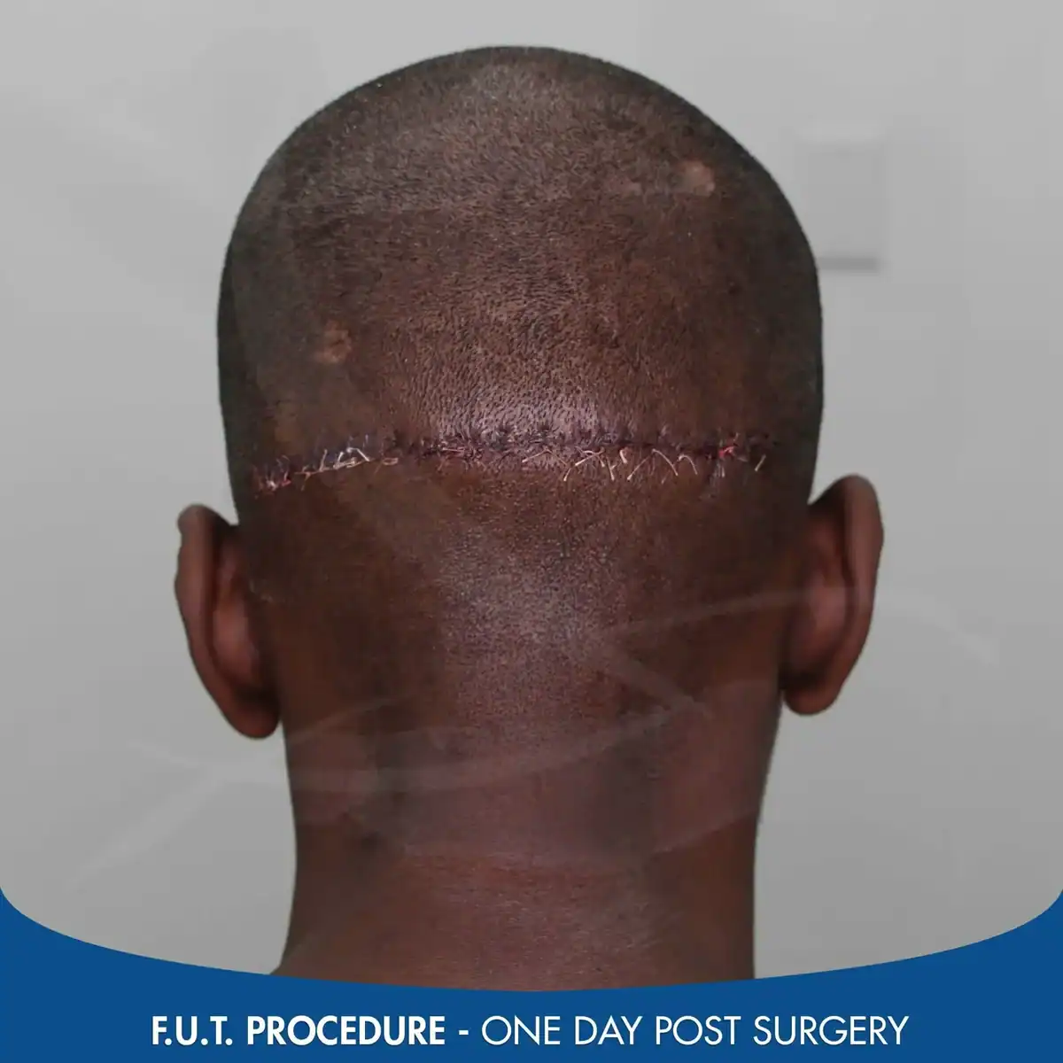 FUT-scar-one-day-post-procedure-1
