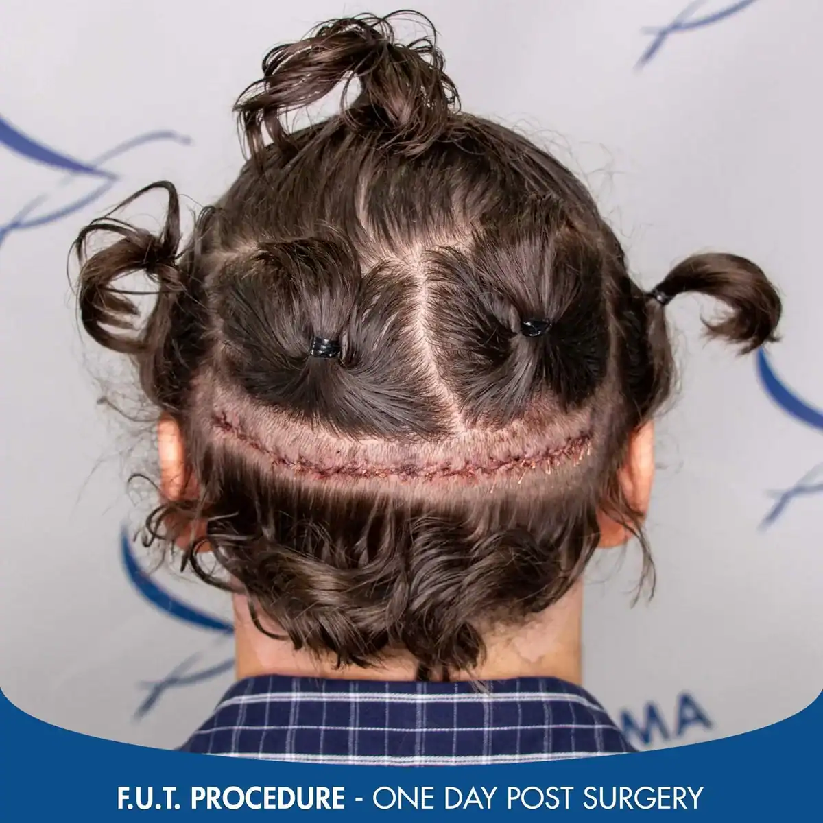 FUT-scar-one-day-post-procedure-2