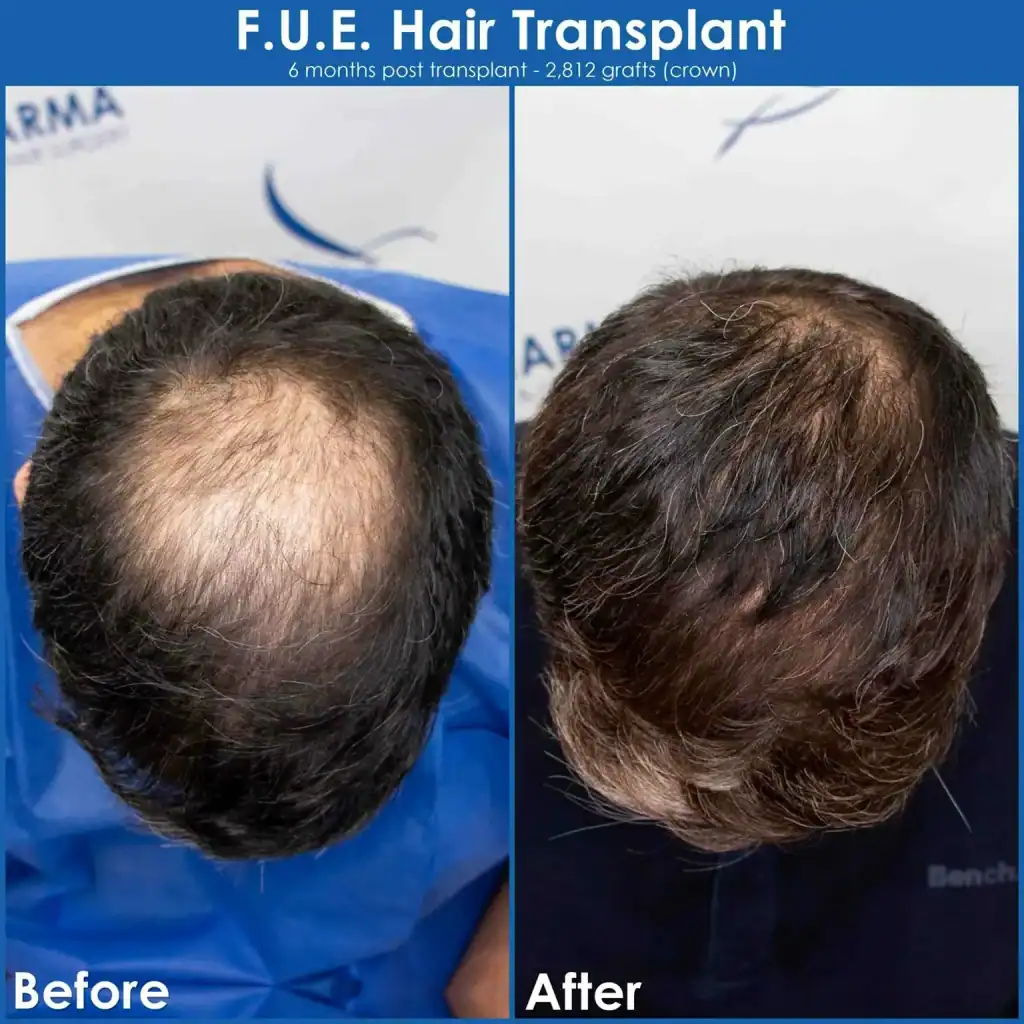 crown-hair-loss-before-and-after-hair-transplant-result