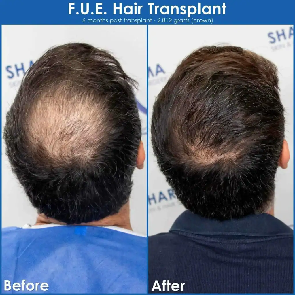 crown-hair-loss-before-and-after-hair-transplant-result-3