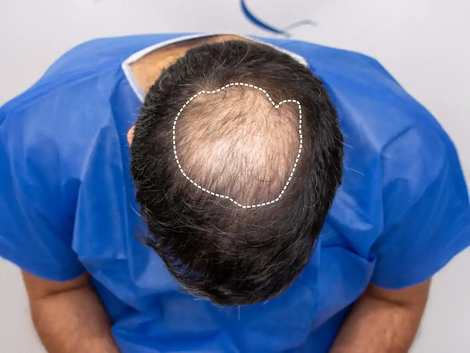 crown-hair-loss