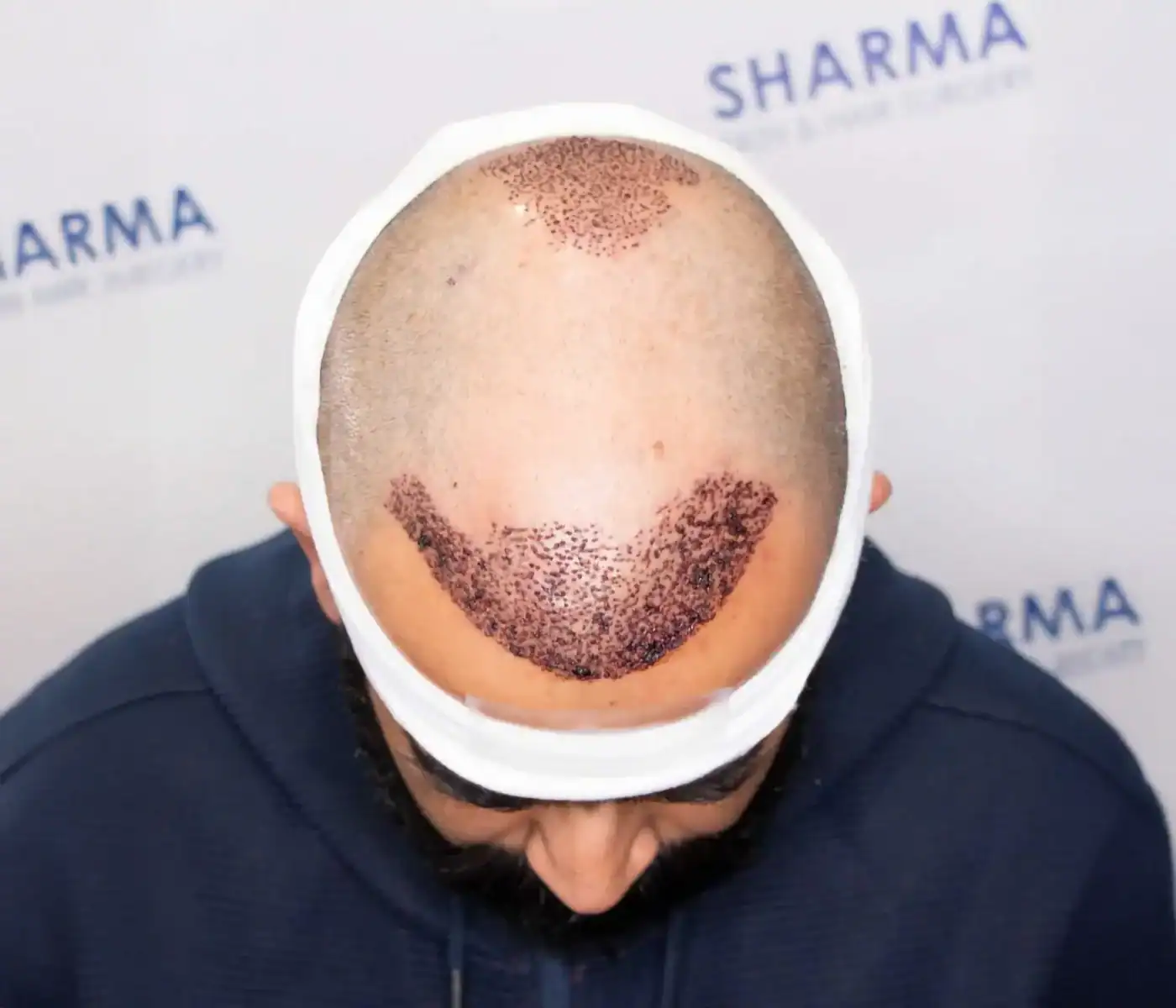 hair-transplant-recovery-one-day-after