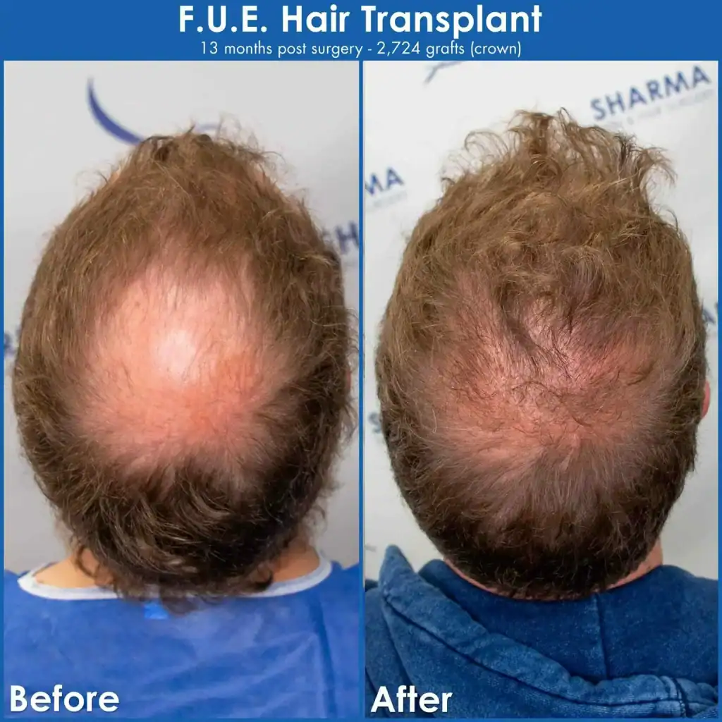 ljarge-bald-spot-restoration-with-hair-transplant