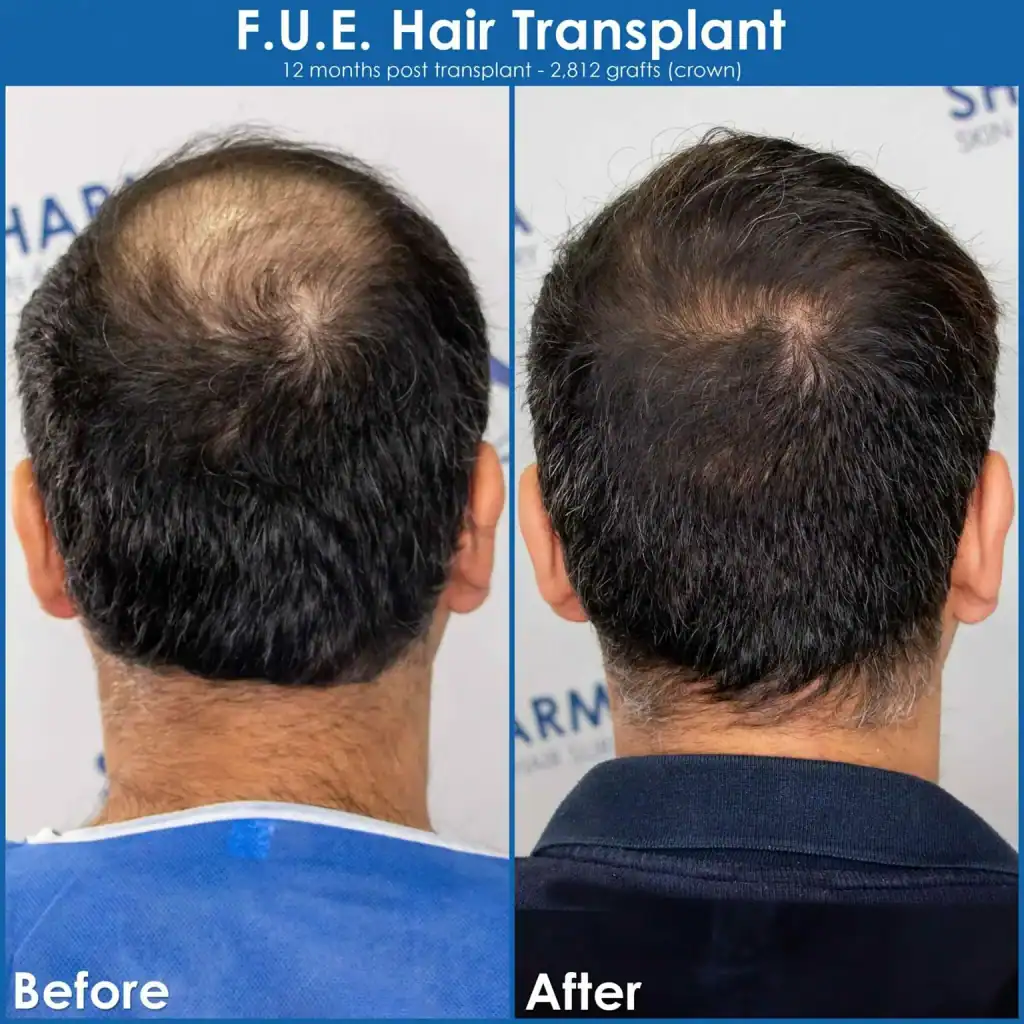 crown-hair-loss-before-and-after-hair-transplant-result-3