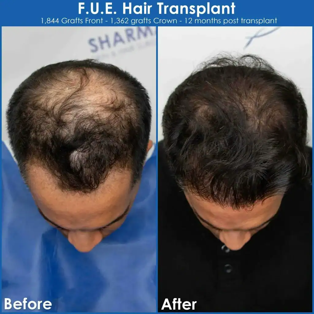 very-large-bald-spot-hair-restoration-before-and-after