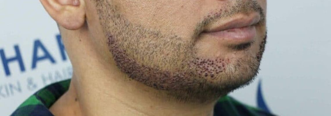 Beard transplant Edmonton