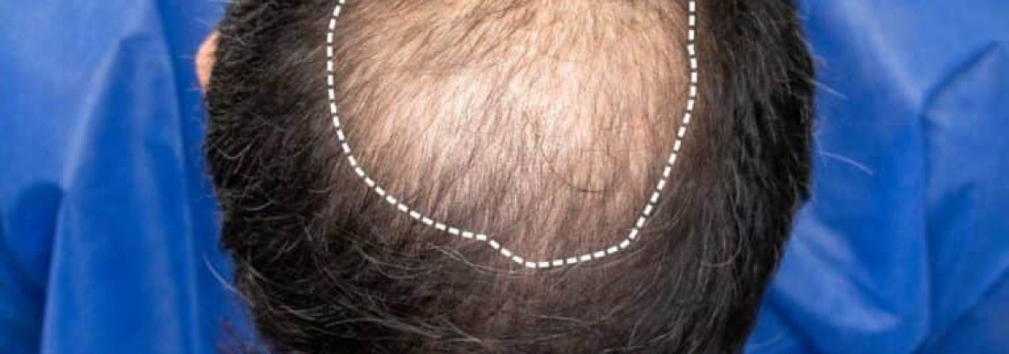 Crown Hair Loss Restoration Edmonton