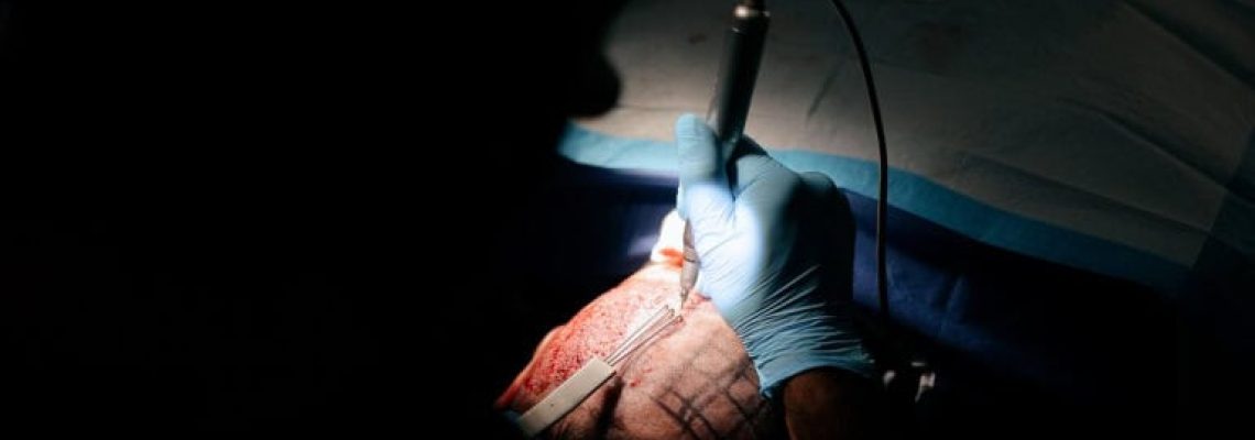FUE hair transplant in Edmonton