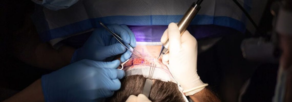 An FUE hair transplant in Edmonton, Canada