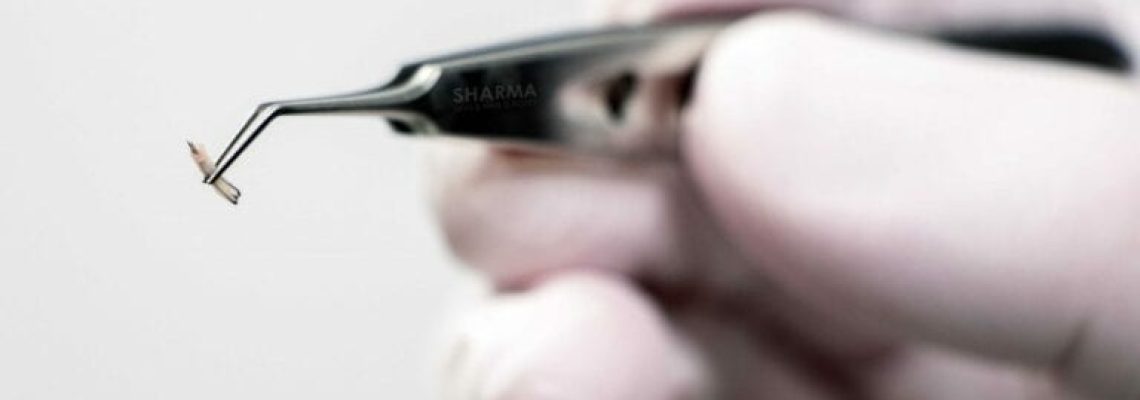 Hair-graft-close-up-photo-multi-hair-graft-the-sharma-clinic