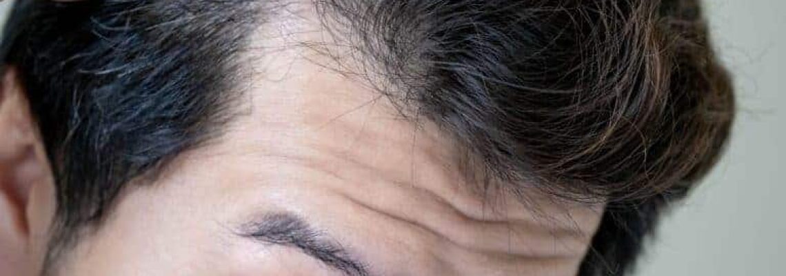 Mature-hairline-vs-receding-hairline