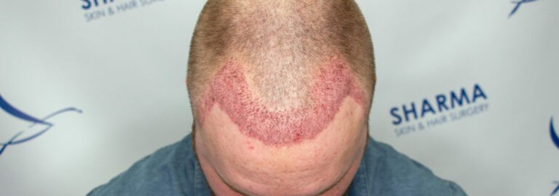 7 days post FUE hair transplant